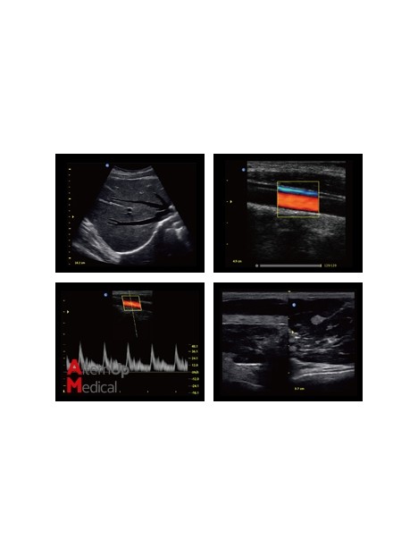 Chison ECO5 Portable Ultrasound