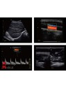 Chison ECO5 Portable Ultrasound