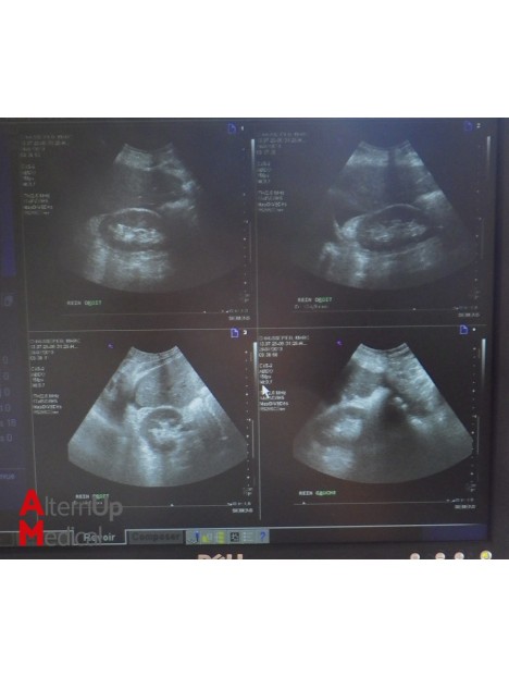 Echographe Siemens Sonoline Antares