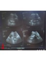 Siemens Sonoline Antares Ultrasound