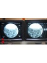 Amplificateur de Brillance GE Stenoscop II