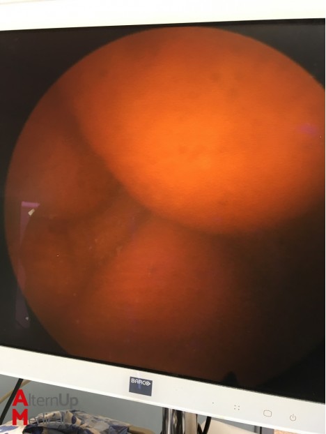 Olympus A4605A 30° Cystoscope